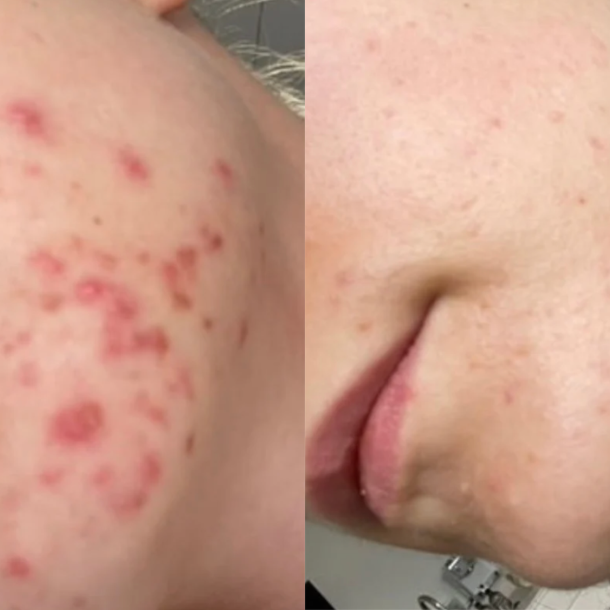 Før: Mette, 12 uger