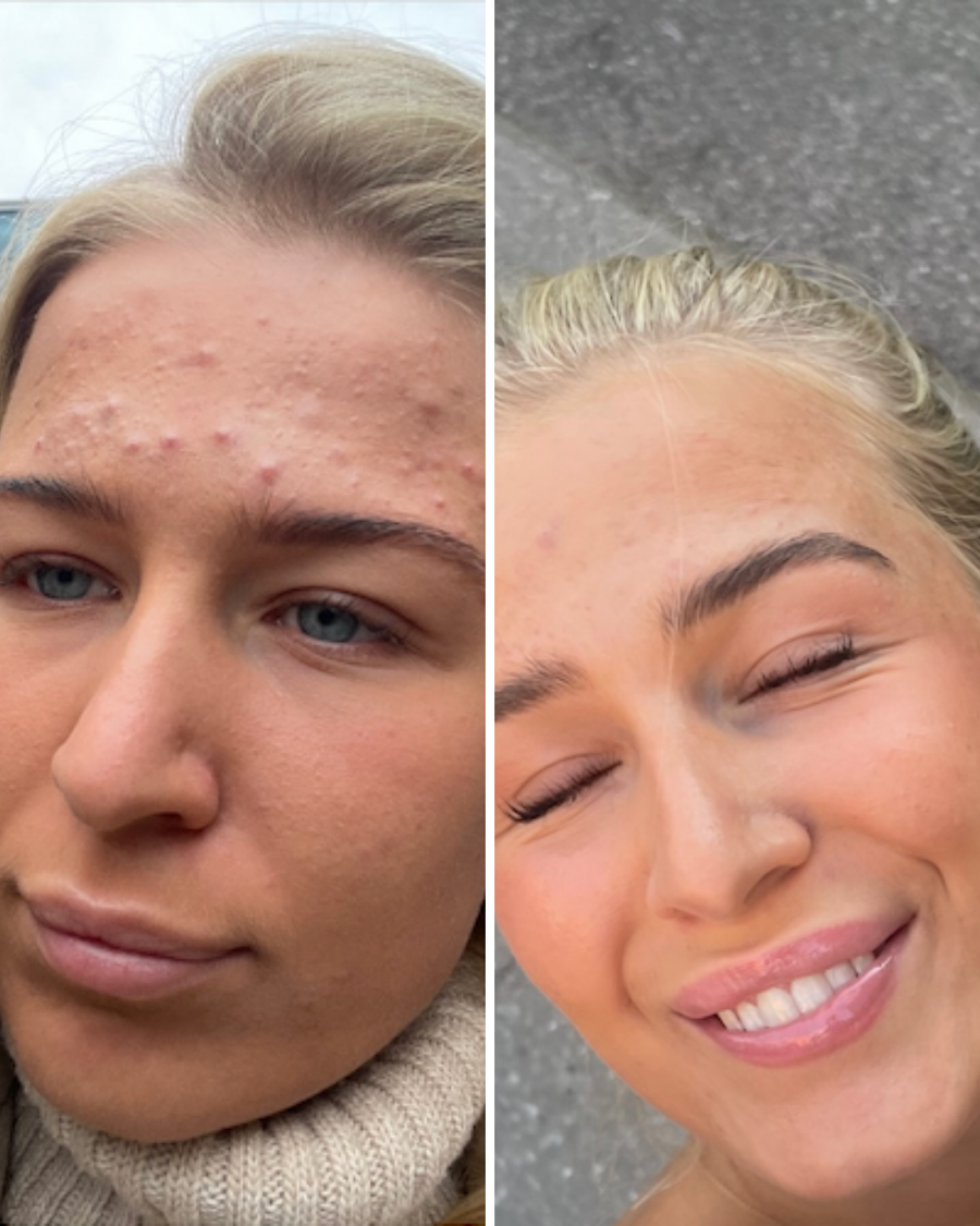 Akne, før og efter