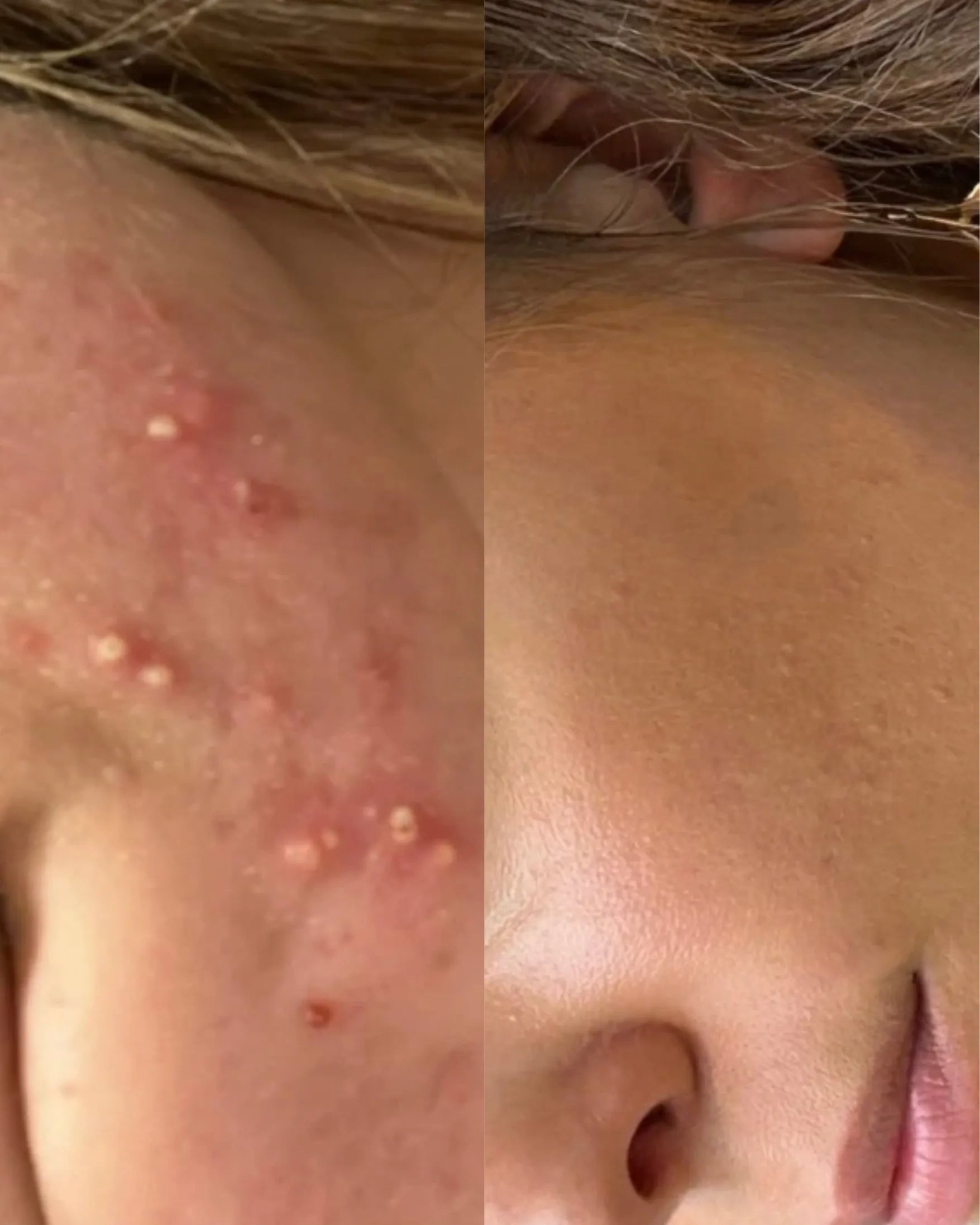 Helbred din akne forløb