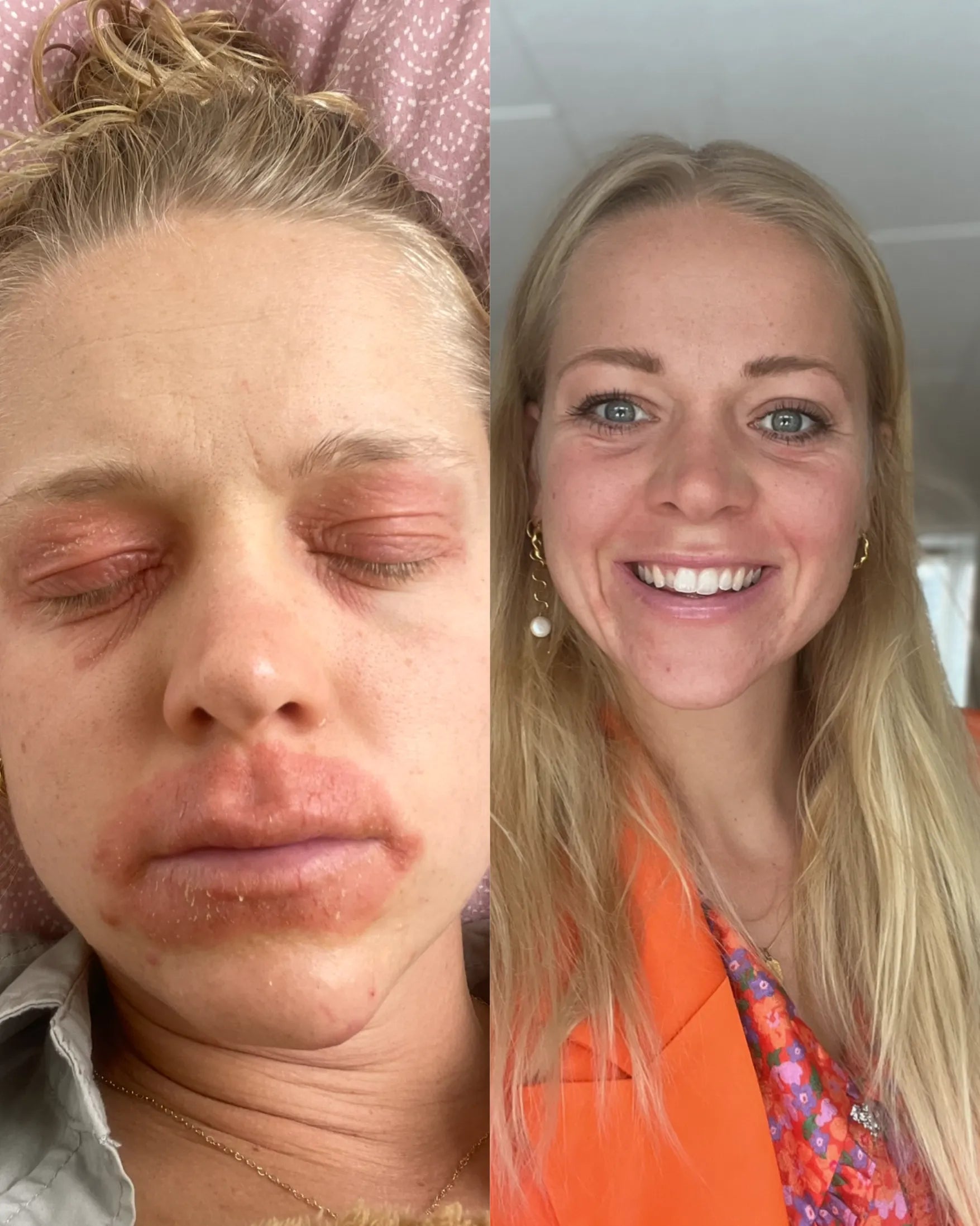 Helbred din eksem forløb